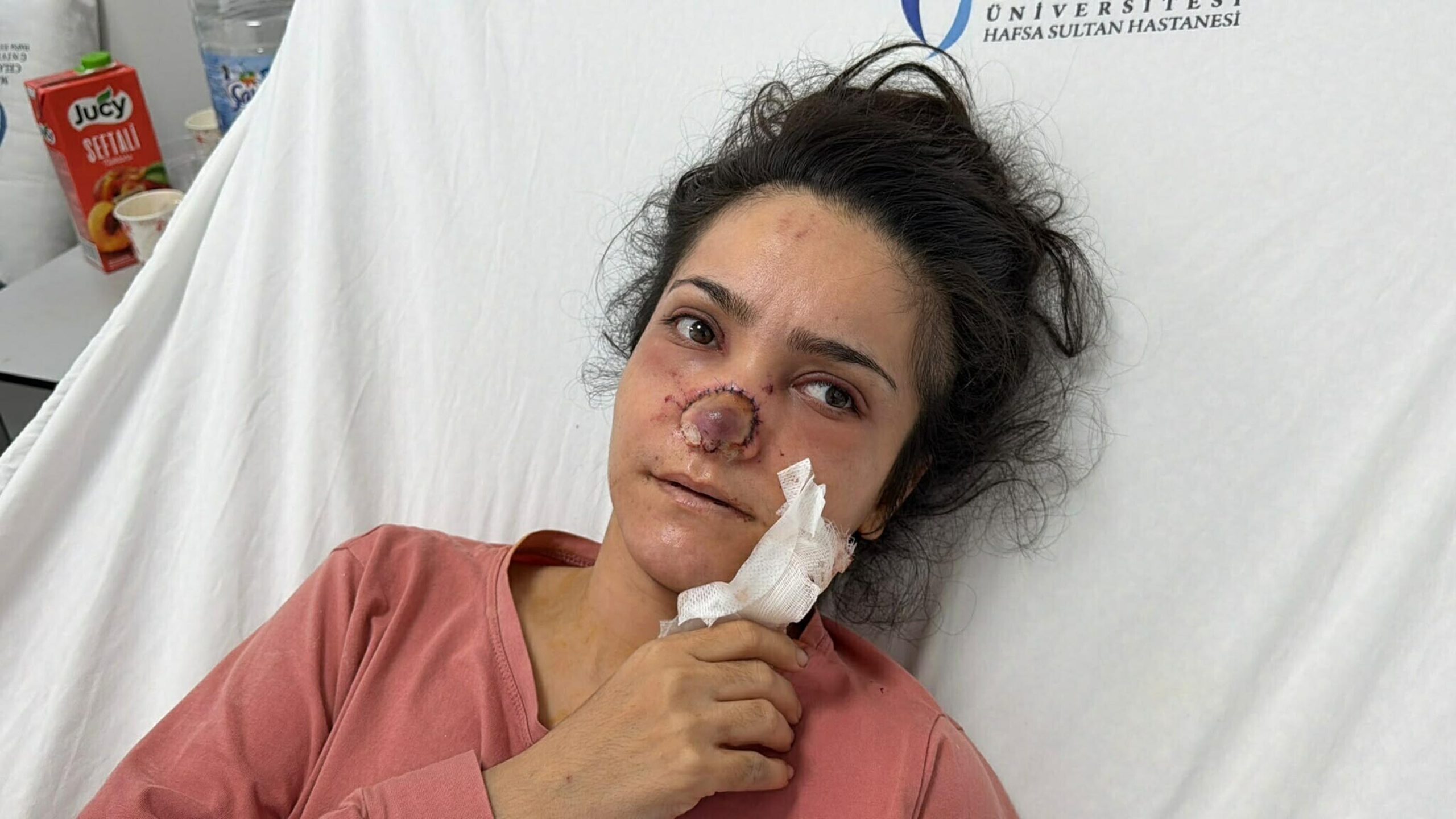 Eşinin burnunu ısırarak kopardığı İmran yaşadığı kabus dolu anları anlattı: Balkondan atlamayı düşündüm!